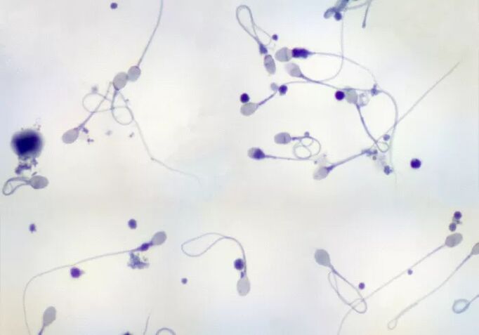 Diagnosi di oligozoospermia - pochi spermatozoi